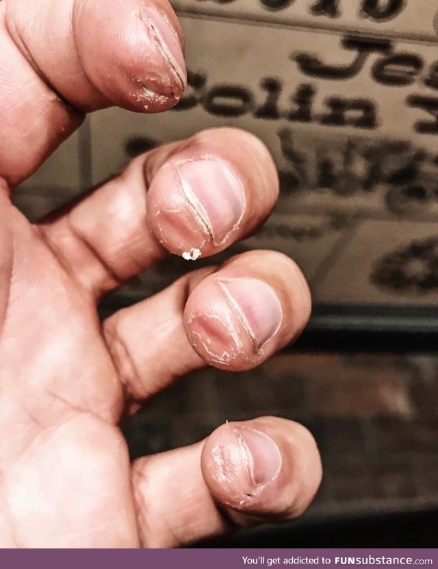 A professional guitarist's fingers at the end of a tour