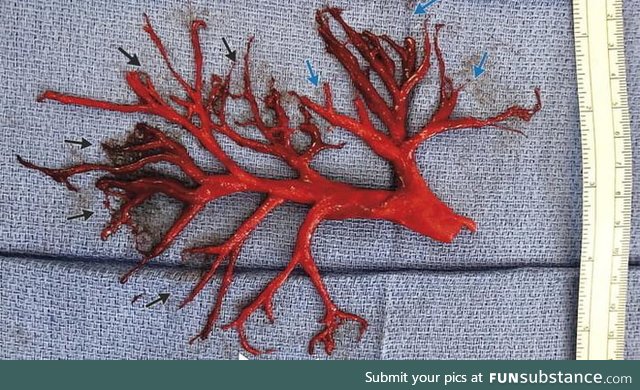 A man coughed up a completely intact, six-inch-wide clot of human blood in the exact