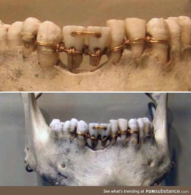 4000 year old dental work on a mummy. The two centre teeth are donor teeth