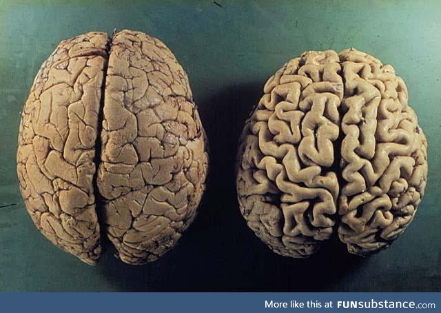 Healthy brain vs. The brain of a person suffering from Alzheimer's