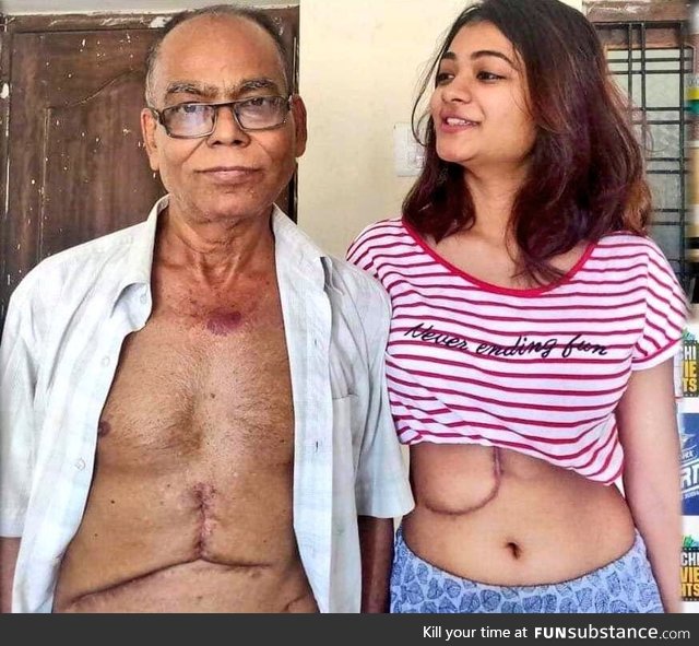 19 years old daughter donated her liver to Father