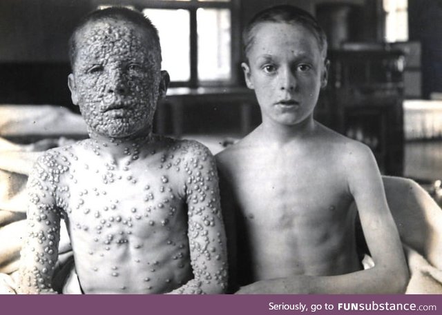Photo of two children - one vaccinated against smallpox, the other not