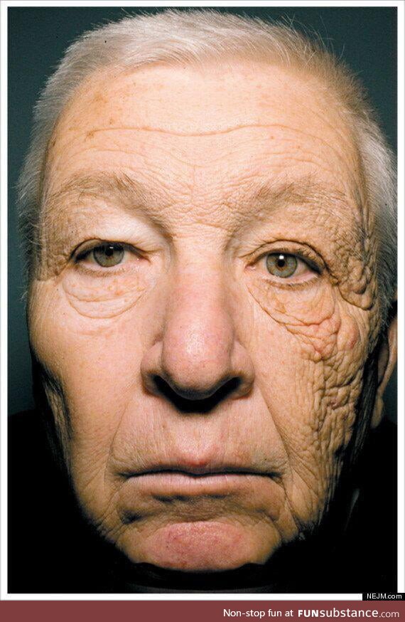 Truck driver showing the effects of sun damage - left side of his face was exposed to