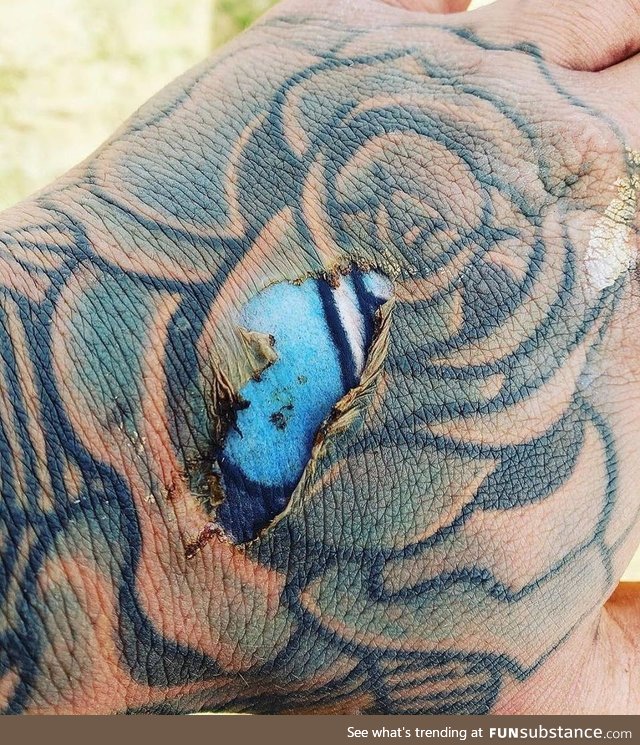 ‌Epidermal burn of the hand exposes bright colors of tattoo ink embedded in the dermal