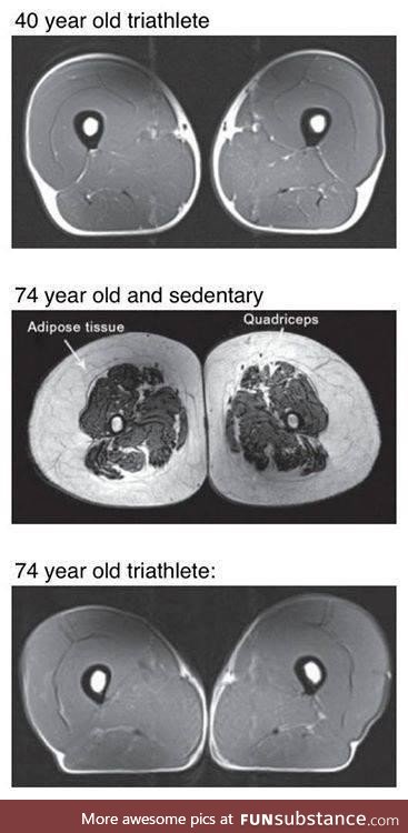 MRI cross sections of leg muscles show the consequences of various lifestyle choices