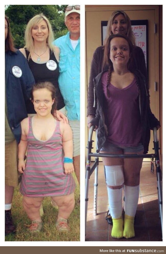 This lady's before and after limb lengthening