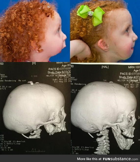This Brave little girl, who was born without a jaw, received a facial. Reconstructive