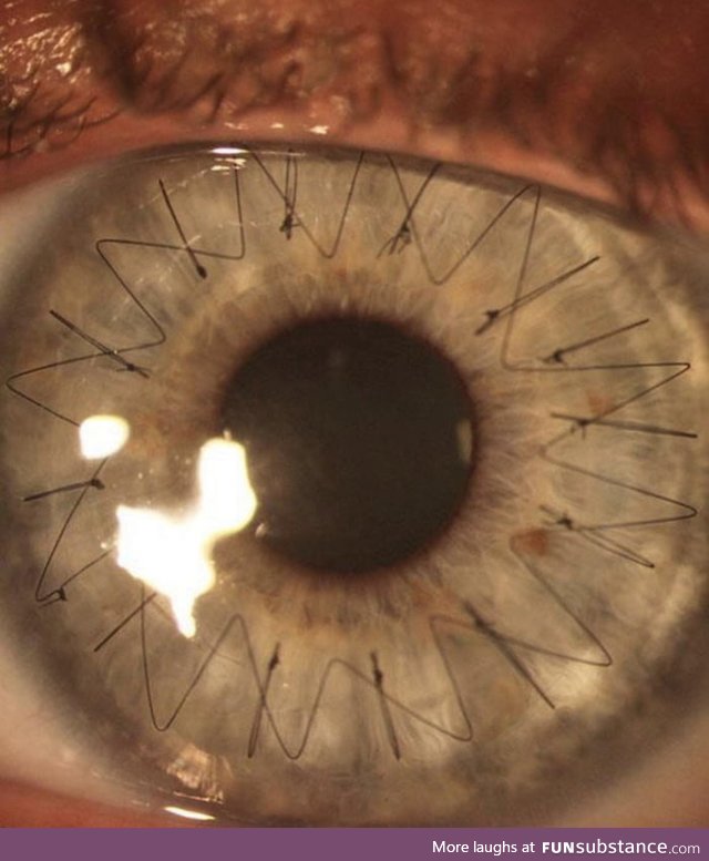 Close up image showing the stitches in the eye after a cornea transplant