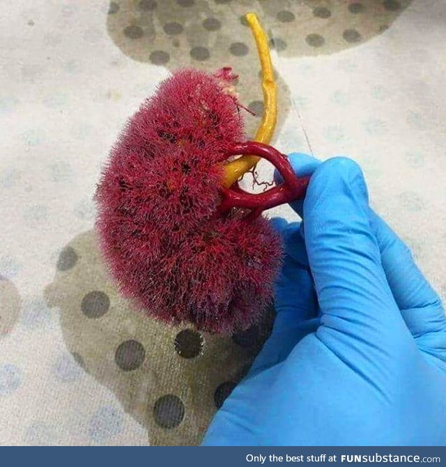 Here's how the kidney looks with its parenchyma removed!
