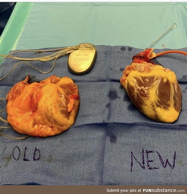 Heart transplant: A bad heart going out and a new heart going in