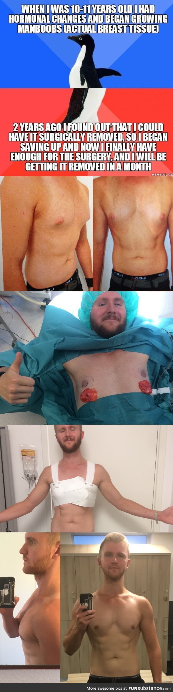 An update to a post I made 2 years ago. The condition is called "Gynecomastia"