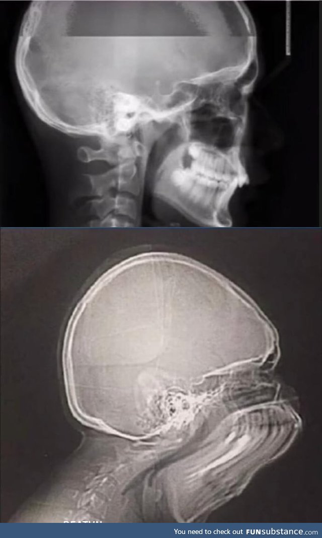 What happens if you sneeze while taking X-ray