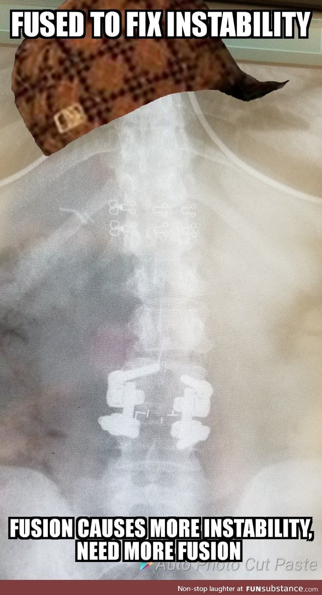 Chronic pain and my spine can suck it!