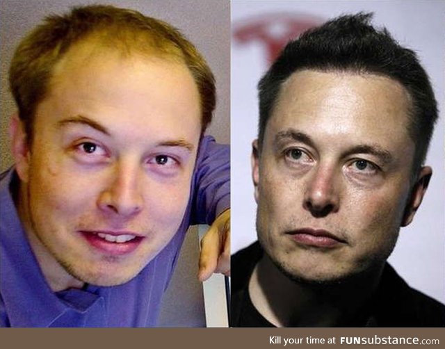 Elon Musk before and after Neuralink implants