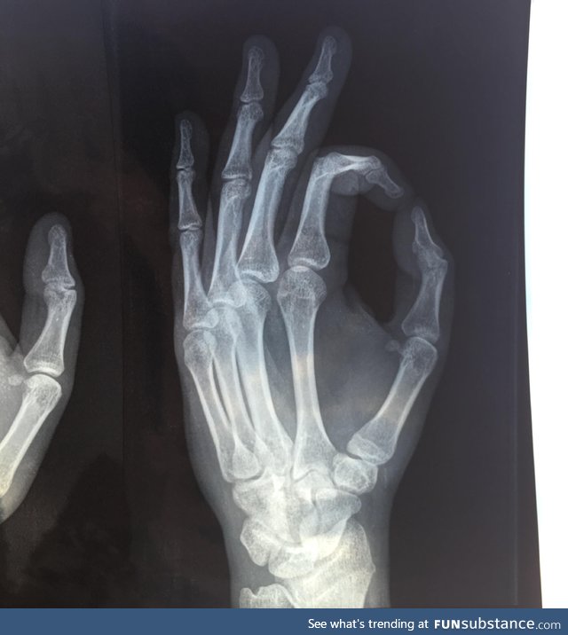 My friend fractured his thumb, then sent me this... He got me good