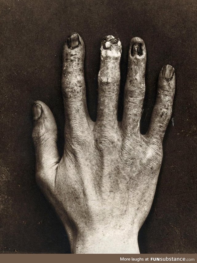 A hand of a radiologist in 1900