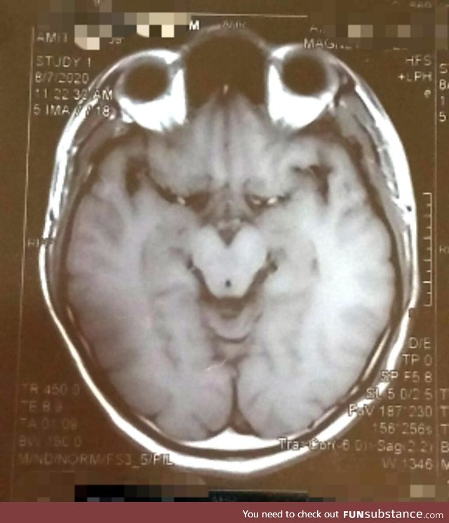 My brain MRI looks like the Grinch