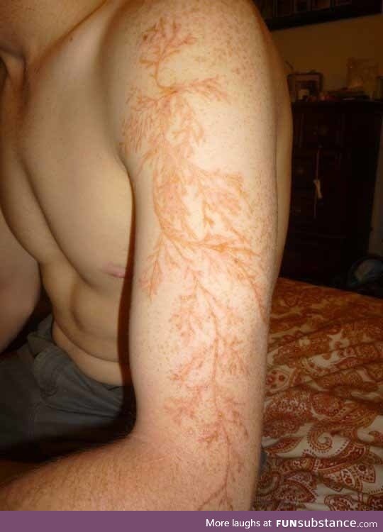 A man's arm after being struck by lightning
