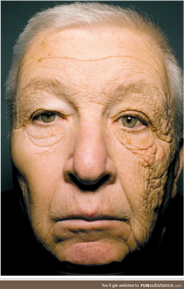 A trucker's skin damage on left side of his face after 28 years on the road