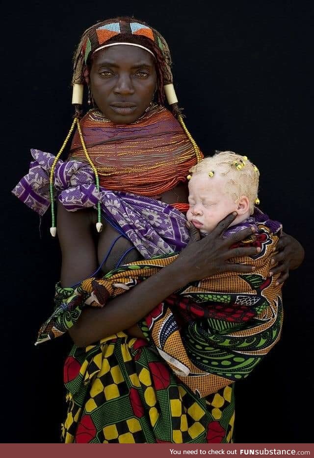 Albino baby girl and her Mwila mother