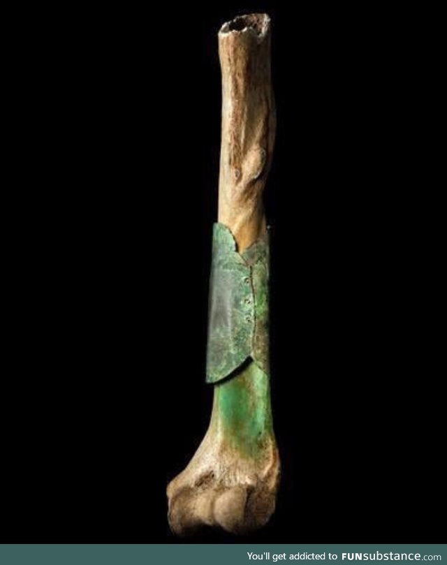 A medieval surgeon repaired bone with riveted copper