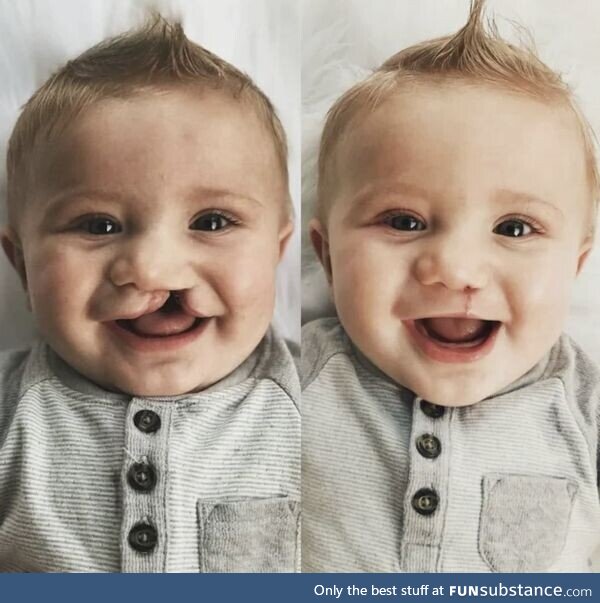 Cleft lip and cleft palate, two week surgery!