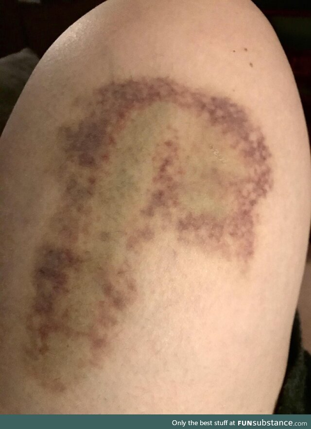 Tell me how I got this bruise