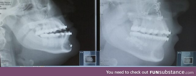 Got jaw surgery, my skull has transformed from chimpanzee to human ????