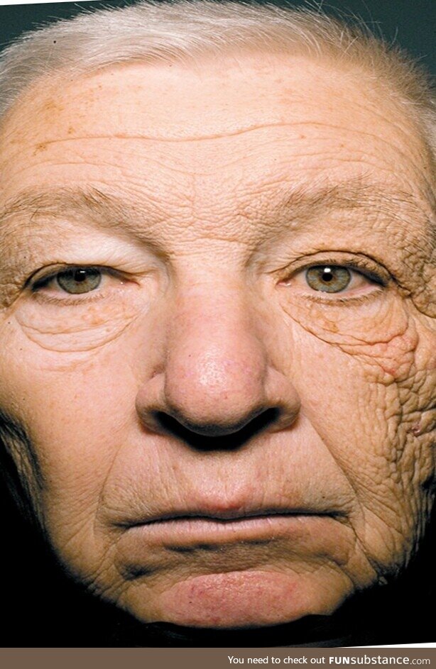 69 year old truck driver. 28 years of left sided sun exposure through the drivers side