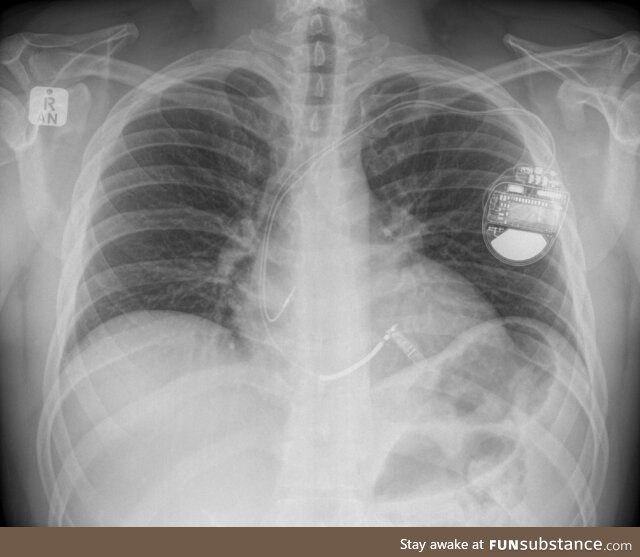 Here's my ICD :-) Been in my body since 2018 and it has saved my life! [OC]