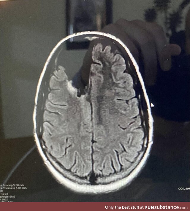 Look how much of my right frontal lobe I can be missing and still function as a human