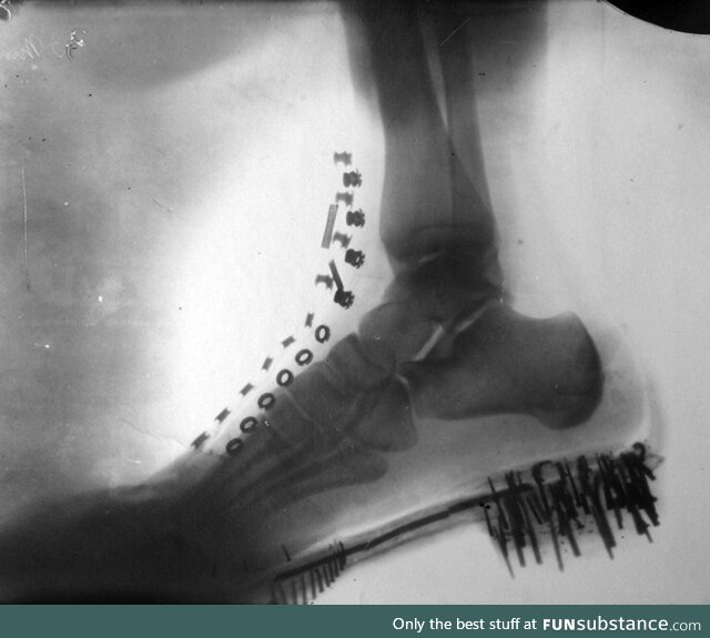 Nikola Tesla’a foot X-ray taken by himself on a machine he designed (1896)