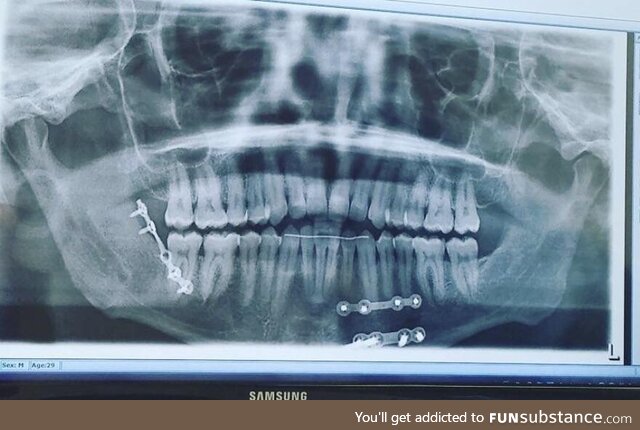 [OC] Got jumped, broke my jaw and I was wired shut. These are the screws holding it all