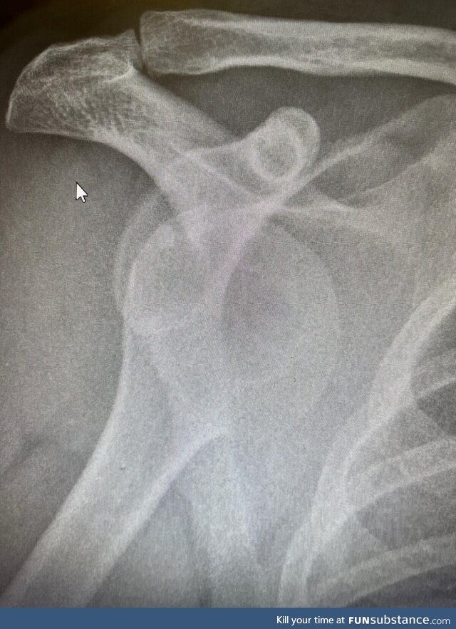 X-ray of my shoulder injury at the weekend