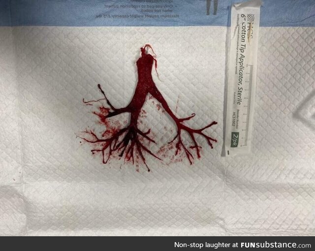 Intact blood clot that was attached to the ETT of a terminally extubated Covid patient