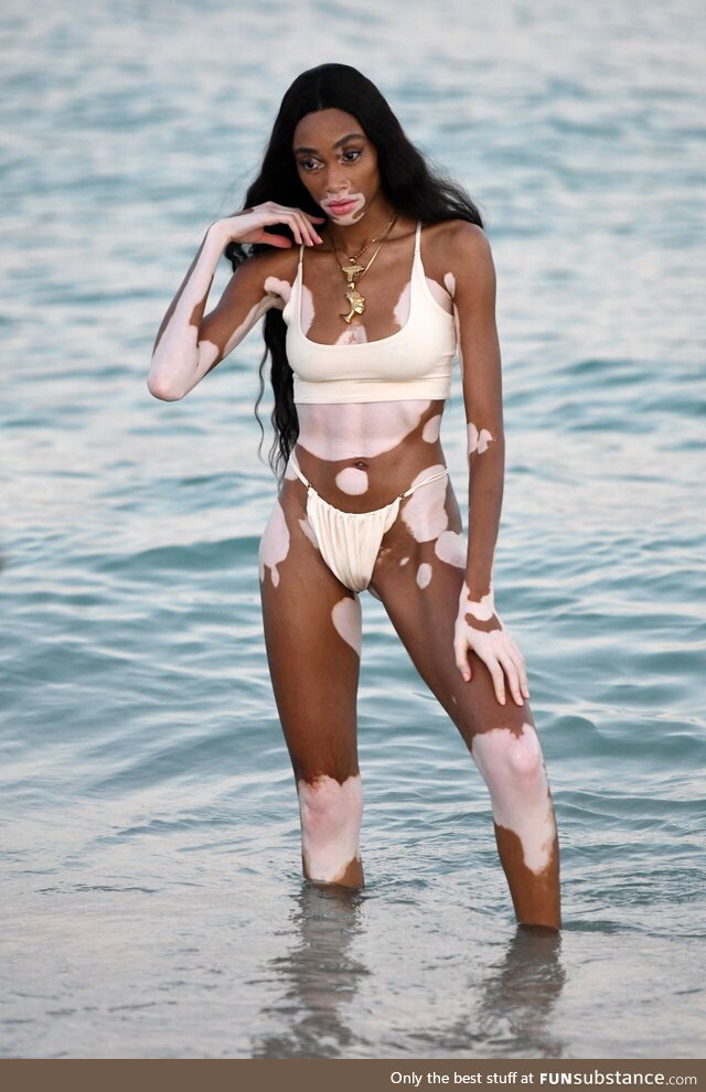 Supermodel Winnie Harlow. Winnie has a skin condition called vitiligo