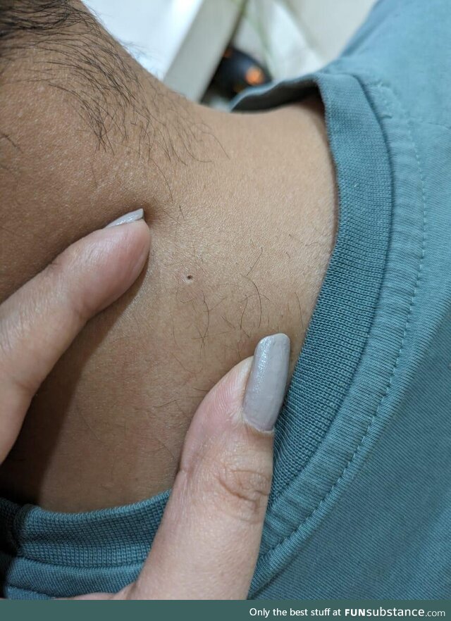 I found this (neat) hole in the back of my neck. How and why did it happen