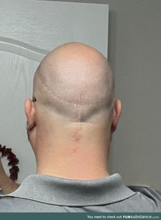 [OC] Sr. Director to me “I’m gonna knit you a cap so no one has to see [your scar]”