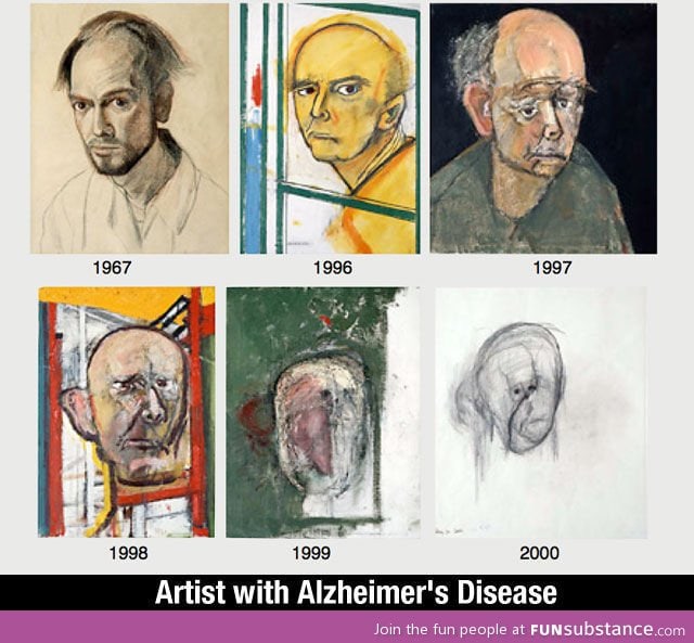 Artist with Alzheimer's deases