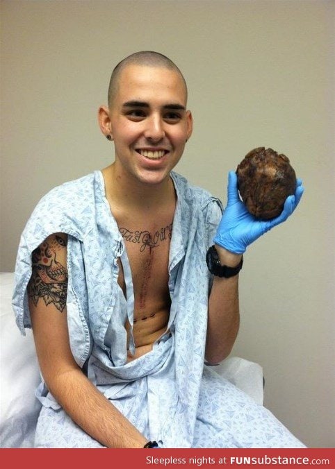 man holds his own old diseased heart after transplant