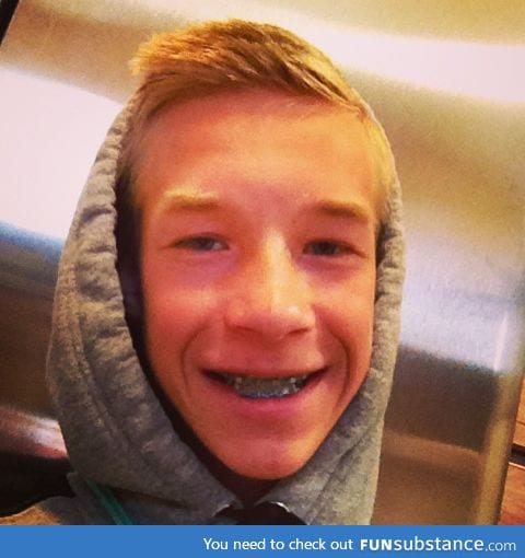 My brace face!