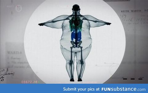 X-Ray of 800 pound man