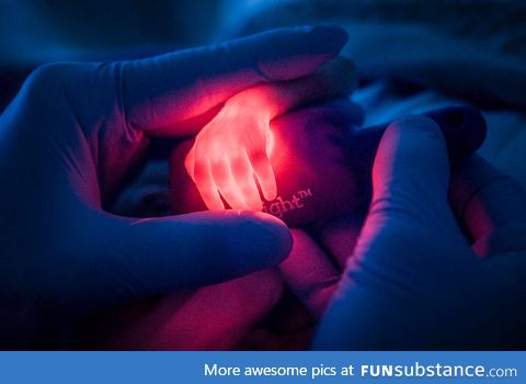 A nurse is looking for a vein on the hand of a premature baby