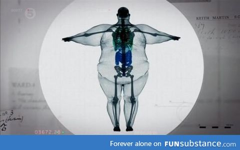 X-ray of a 900 pound man