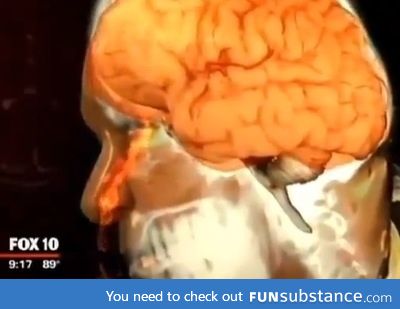 He thought he had a runny nose for 18 months. He was leaking brain fluid