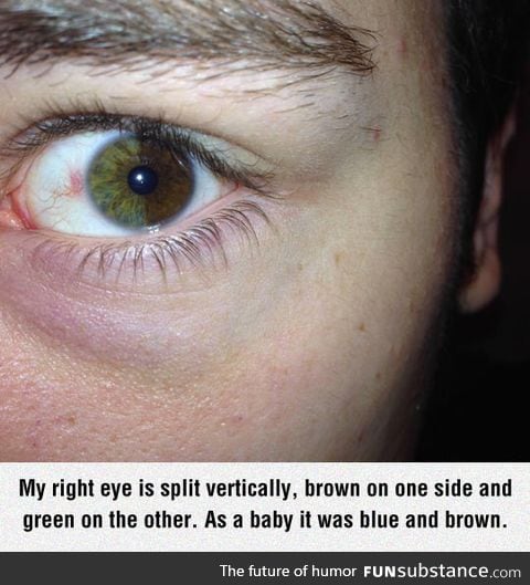 Sectoral heterochromia