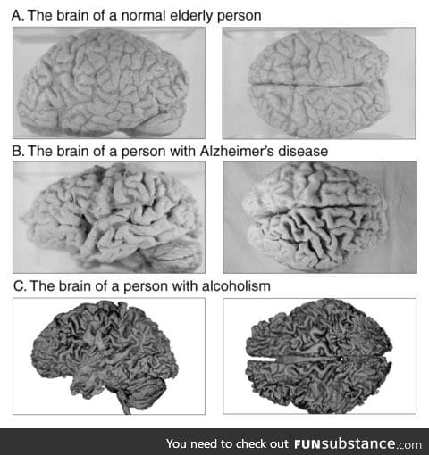 This is what happens to your brain if you have Alzheimer's or a Drinking Problem...