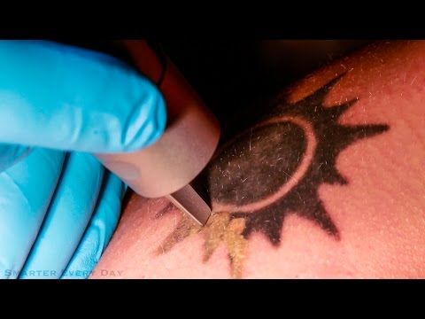 Watching how a tattoo is removed will give you thrills