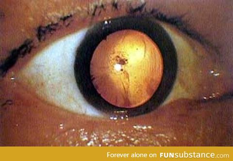 "Nuclear bomb" cataract on a Hiroshima bomb victim