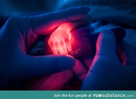 Nurse trying to find a vein in a premature baby